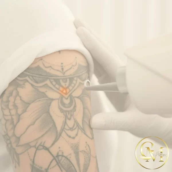 Tattoo Laser Removal